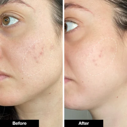 iNNBEAUTY PROJECT Pimple Paste Overnight Blemish Spot Treatment - Imagen 6